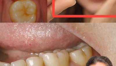 How to naturally repair a cavity. Keep these tips in mind to avoid visiting the dentist…See more